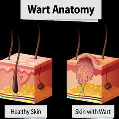 Warts And Skin Tag Removal
